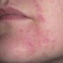 Что делать при аллергическом дерматите на лице?