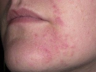 Что делать при аллергическом дерматите на лице