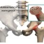 Что делать при асептическом некрозе головки бедра?
