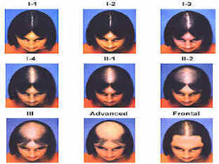 Что такое диффузное выпадение волос