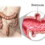 Дивертикулярная болезнь кишечника(дивертикулез) толстого кишечника