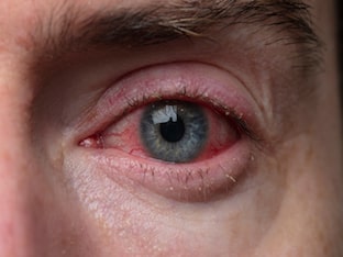 Как лечить хламидийную инфекцию глаз, симптомы