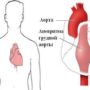 Как лечится аневризма грудного отдела аорты?