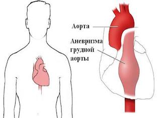Как лечится аневризма грудного отдела аорты