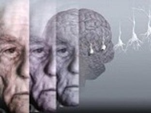 Как начинается болезнь Альцгеймера: первые проявления