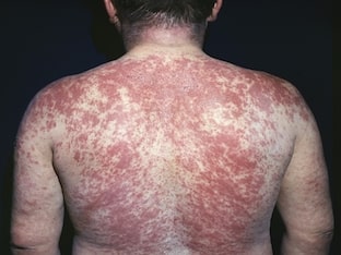Какие характерные симптомы атопического дерматита у взрослых