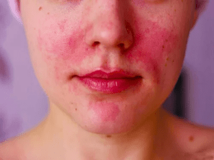 Почему бывает аллергия на косметику и как ее избежать