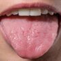 Почему на языке появляется красный налет?