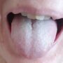 Почему возникает белый налет на языке