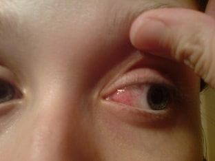 Почему возникает давящая боль в левом глазу
