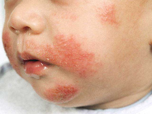 то делать при пищевой аллергии у детей