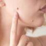 Удаление папиллом: как избавиться от папилломы?