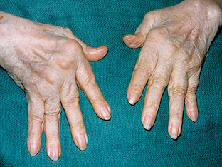 Ювенильный артрит: особенности и лечение