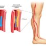 Заболевание периферических артерий: причины, симптомы, лечение