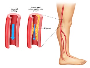 Заболевание периферических артерий: причины, симптомы, лечение