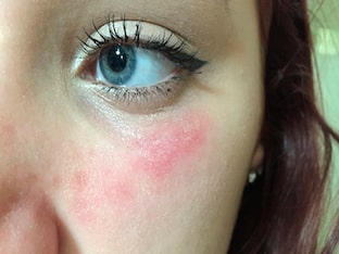 Аллергия на лице, чем лечить аллергию