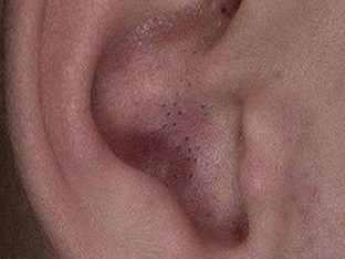 Что делать с черными точками в ушах, как избавится