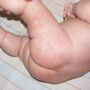 Что такое пеленочный дерматит и как его лечить?
