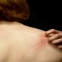 Что такое «зуд на нервной почве»?