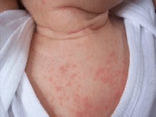 Если у ребенка аллергия, что делать, причины