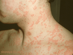 Как и чем лечить аллергию на коже