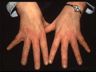 Как лечить аллергию на руках, причины