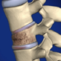 Как лечить остеопороз позвоночника?