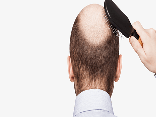 Как лечить выпадении волос