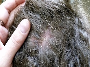 Как вылечить дерматит волосистой части головы