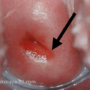 Как вылечить эрозию шейки матки?