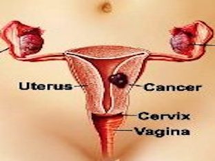 Какие симптомы и признаки имеют раковые заболевания матки