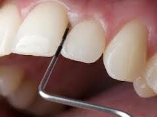 Какие зубные пасты рекомендуются при пародонтозе