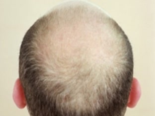 Народное лечение алопеции (выпадения волос, облысения)