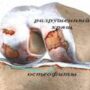 Нетрадиционные методы лечения остеоартрита