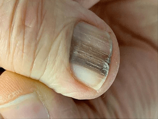 Почему появляются черные полоски на ногтях