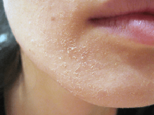 Почему шелушится кожа на лице, что делать