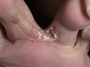 Почему трескается кожа между пальцами ног, что делать