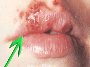 Простуда на губах: лечение и профилактика простого герпеса
