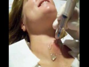 Как делается биопсия щитовидной железы