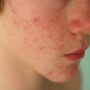 Как избавиться от прыщей в домашних условиях?