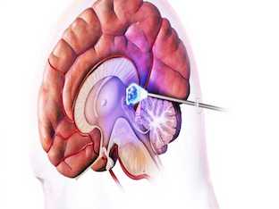 Как лечить кисту пинеальной железы головного мозга