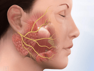 Как лечить невралгию лицевого нерва