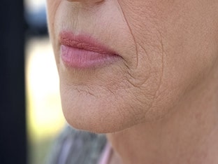 Морщины вокруг губ: как избавиться и убрать навсегда