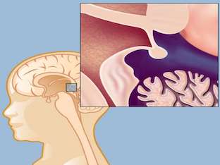 Опасна ли киста пинеальной железы головного мозга