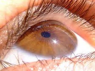 Почему появляется аллергия на глазах, лечение