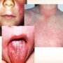 Скарлатина: симптомы и лечение